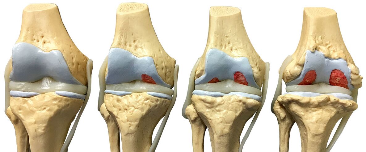 Stages of knee arthrosis joint