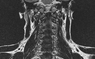 Cervical spine