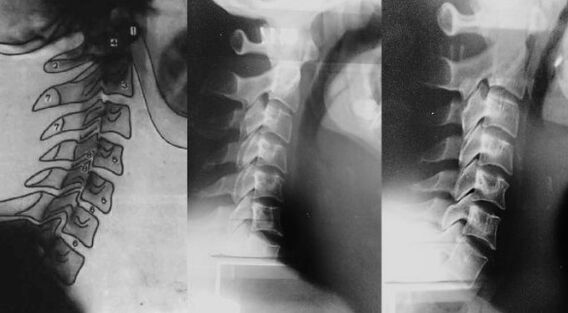 Neck with displacement of the first cervical vertebrae