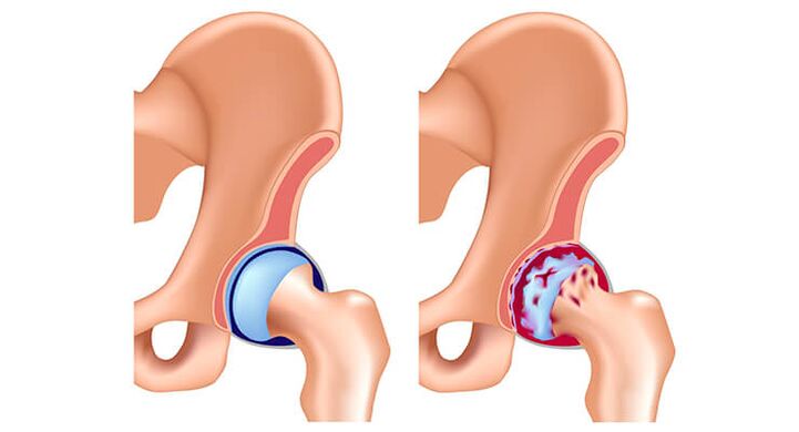 Hip arthrosis