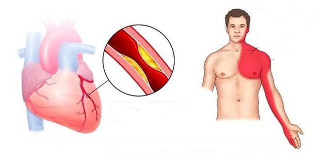 Carden syndrome